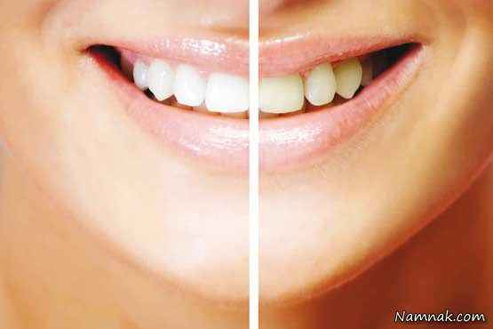 درمان دندان های فاصله دار ، زیبایی دندان ، زیبایی دندان بدون ارتودنسی