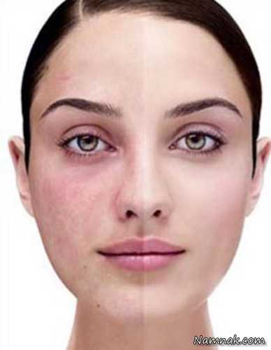 درمان طبیعی لک و مک صورت
