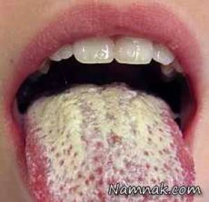 برفک دهان ، برفک دهان نوزادان