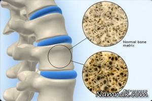 کاهش کلسیم ، علت دفع کلسیم از بدن