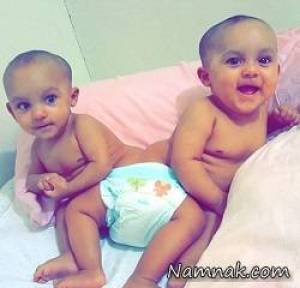 دوقلوهای به هم چسبیده