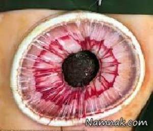 غول مویی ، عکس سندرم راپونزل
