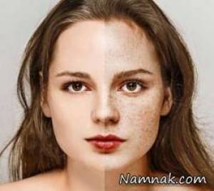 لکه های پوستی ، درمان سریع لکه های صورت
