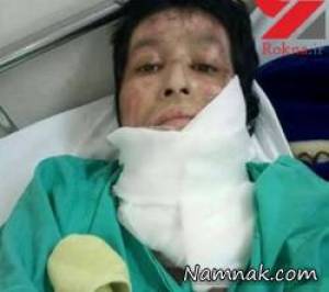 شوهر دیوانه ، سوزاندن صورت زن زیبا توسط شوهرش
