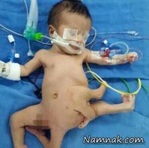 نوزاد 8 دست و پا ، جراحی جدا کردن دست و پای اضافی نوزاد عراقی