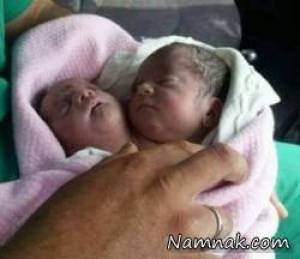نوزاد 2 سر ، تولد نوزاد با دو سر