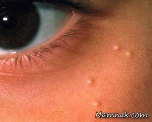 درمان میلیا ، milia treatment