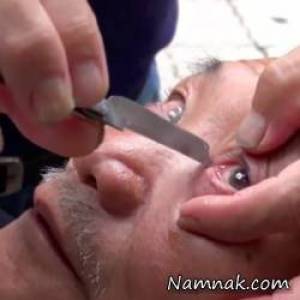 تخم چشم ، تراشیدن داخل چشم