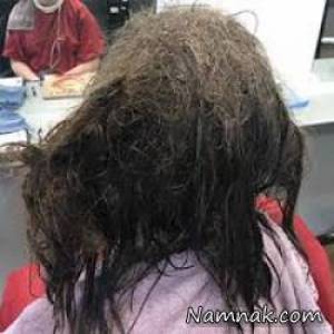 شپش مو ، موهای پر از شپش