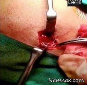 کرم زنده صورت ، جراحی کرم داخل صورت