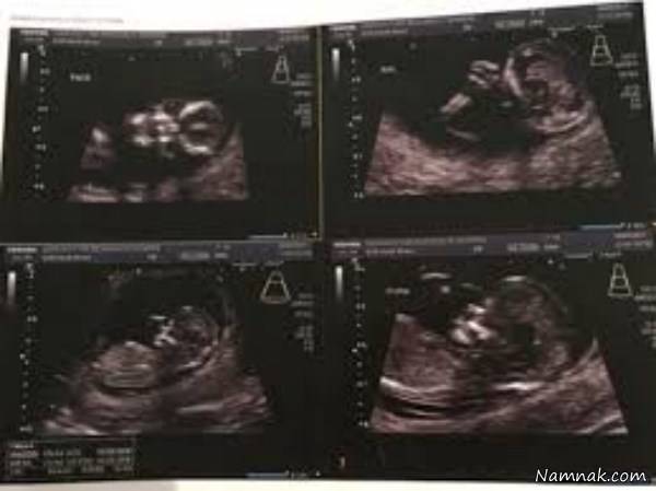 وحشت مادر از عکس سونوگرافی جنین داخل شکمش + عکس 