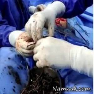 میخ داخل شکم ، خوردن میخ