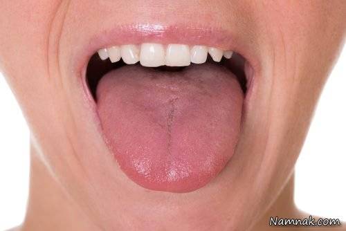 علائم و نشانه های سرطان زبان سرطان زبان