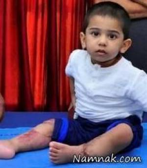 پای قطع شده ، عکس پای قطع شده