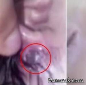 کرم گوشتخوار ، سوراخ شدن صورت نوزاد توسط کرم ها
