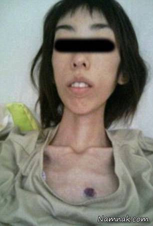 دختری که در اثر شکنجه های پدر و مار بزرگش 16 کیلو شد+عکس 1