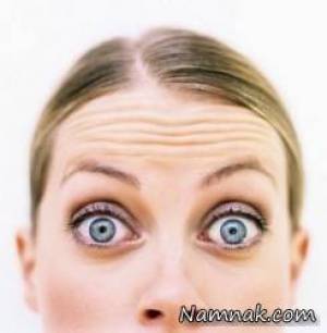 بوتاکس پیشانی ، Soften the Lines on Forehead