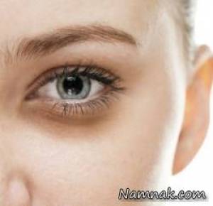 درمان کیسه زیر چشم ، eliminate eye bags without surgery