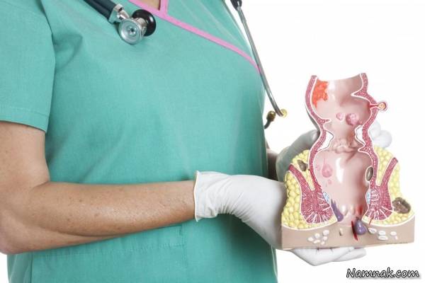 راه پیشگیری از هموروئید پیشگیری از هموروئید