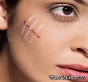 درمان اسکار کلوئید ، treat keloid scars naturally