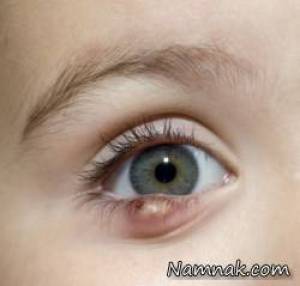 درمان گل مژه ، natural remedies for eye stye
