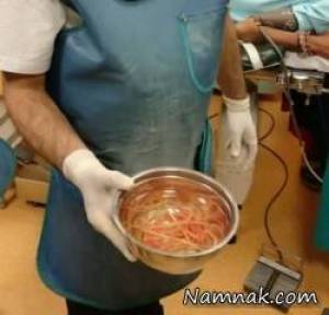 کرم زنده ، درد شدید شکم