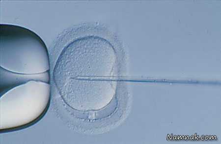 میکرواینجکشن یا تزریق اسپرم داخل تخمک (ICSI) ، لانه گزینی جنین درای وی اف ، میکرواینجکشن یا تزریق اسپرم داخل تخمک icsi
