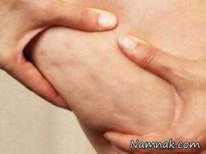 سلولیت ، دلیل سلولیت