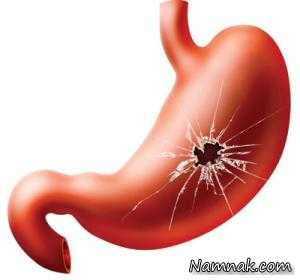 سوراخ شدن معده ، نشانه های زخم معده چیست؟