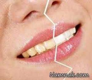 پوسیدگی دندان ، پوسیدگی دندانهای جلو
