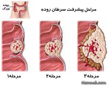 سرطان روده کوچک ، سرطان روده و پولیت