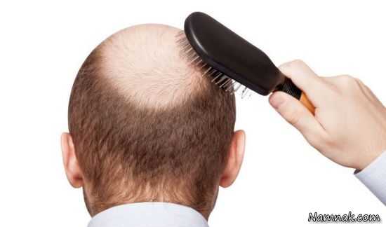 درمان طبیعی ریزش مو در مردان