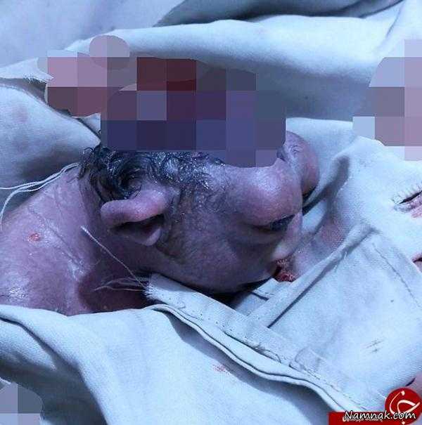 عکس نوزاد عجیب الخلقه در هند عکس نوزاد عجیب الخلقه ، تولد نوزاد عجیب ، کودک عجیب هندی