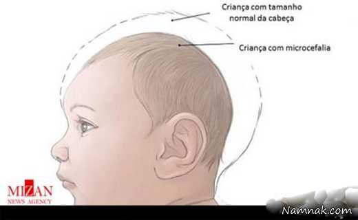 ویروس زیکا ، علائم ویروس زیکا ، ویروس زیکا چیست
