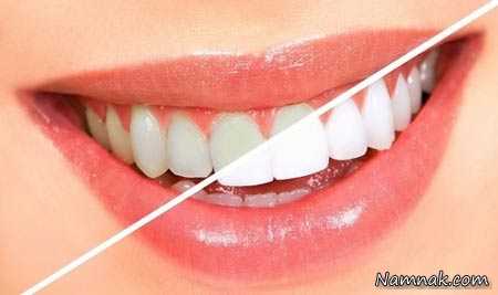 سفید شدن دندان ، سفید شدن دندان ها ، ساده ترین روش سفیدشدن دندان