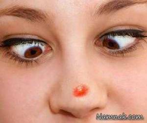 آرایش جوش صورت