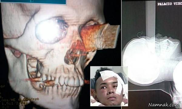 فرو رفتن کامل چاقو در چشم