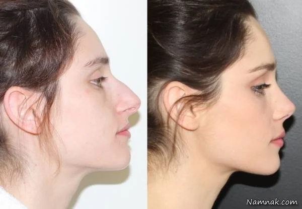 عکس قبل و بعد جراحی بینی جراحی بینی