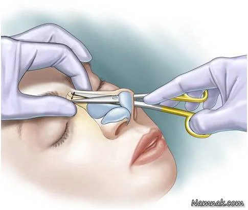 روش بسته جراحی بینی جراحی بینی