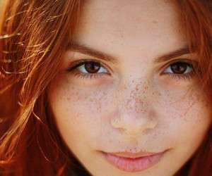 لکه های پوستی ، لکه های پوستی سفید