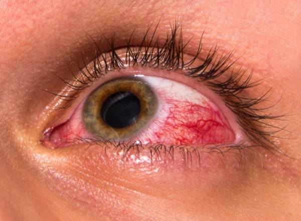 عوامل عفونت چشم