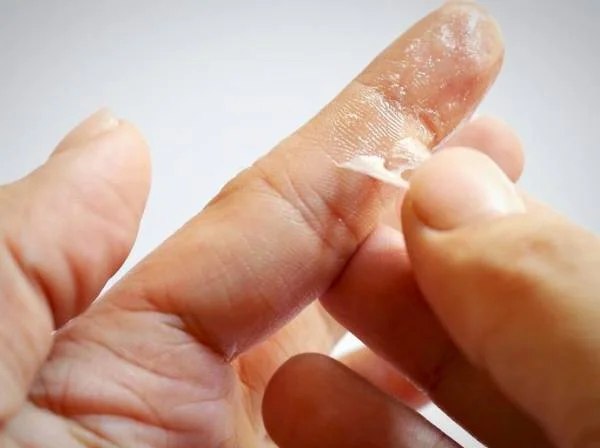 کندن چسب قطره ای از روی دست پاک کردن لکه چسب 123 از روی دست