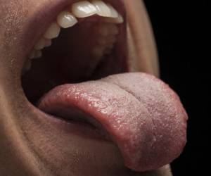 سوختگی زبان ، علت سوختگی زبان چیست