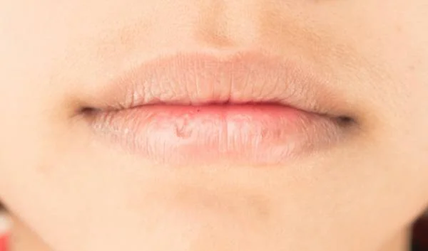 علت خشکی و پوسته شدن لب علت خشکی لب ها