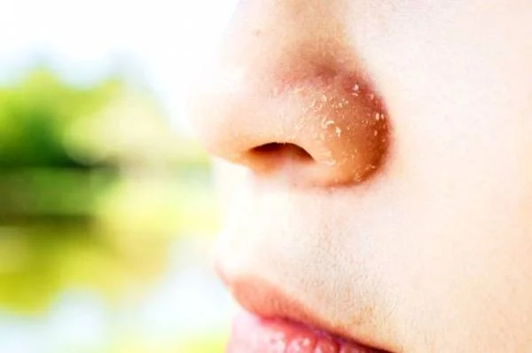 پوسته پوسته شدن روی بینی خشکی پوست بینی