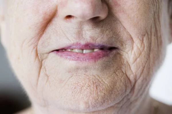 افزایش سن علت پوسته پوسته شدن روی بینی افزایش سن