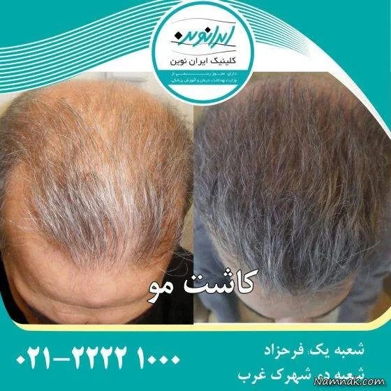 کاشت مو