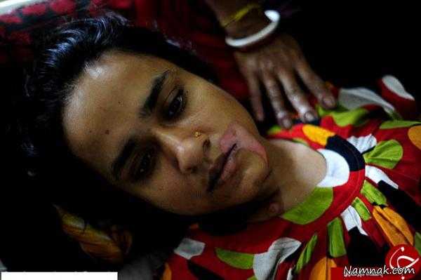 دختر بنگلادشی ، اسیدپاشی ، ریختن اسید به دهان