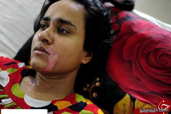 دختر بنگلادشی ، ریختن اسید به دهان ، تازه عروس