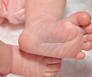 کج شدن پای نوزاد